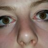 Tränenrinnen oder Tränensäcke: Unterspritzungen mit Hyaluron - 28207