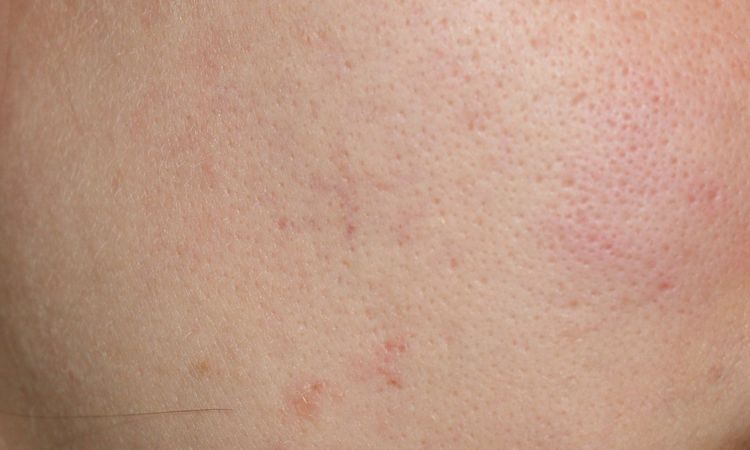 Große Poren und schlechte fettige Haut - 28211