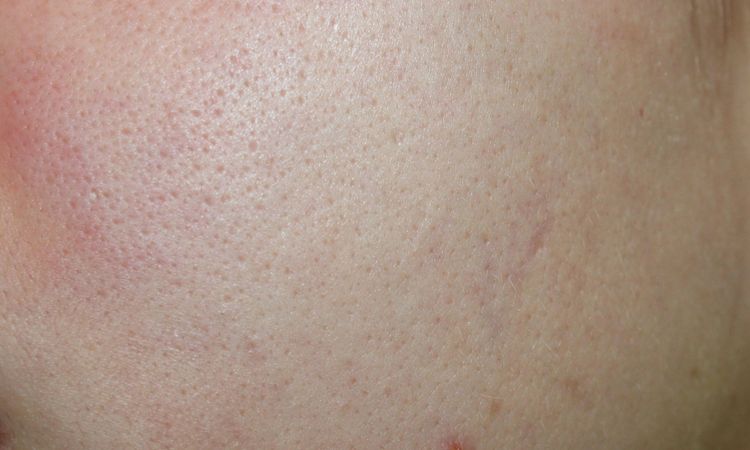 Große Poren und schlechte fettige Haut - 28212