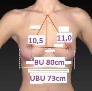 Brustvergrößerung von A auf C/D mit Allergan TRX 340 bei 175 cm, 55 kg - 28222