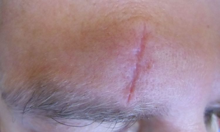Beseitigung der Narbe an Stirn - 28254