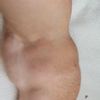 Suche Arzt für Operation von Multilipomen an Armen und Beinen