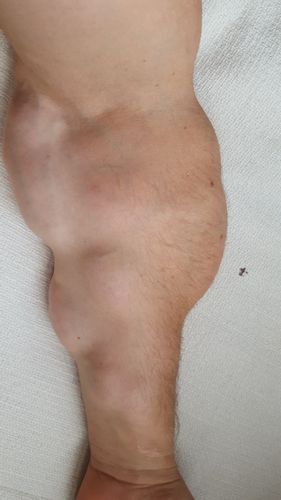 Suche Arzt für Operation von Multilipomen an Armen und Beinen