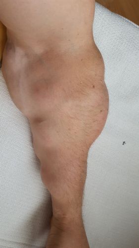 Suche Arzt für Operation von Multilipomen an Armen und Beinen