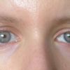 Verbesserung von Augenasymmetrie - 28361