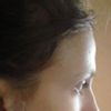 Profilkorrektur: fliehendes Kinn, prominente Nase, flache Stirn - 28378