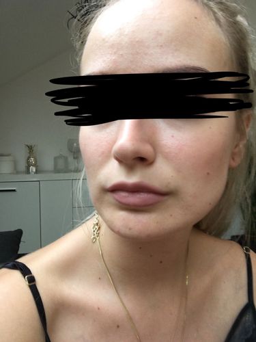 Kinn-Verschmälerung, Jawline OP