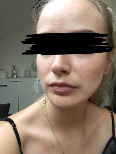 Kinn-Verschmälerung, Jawline OP