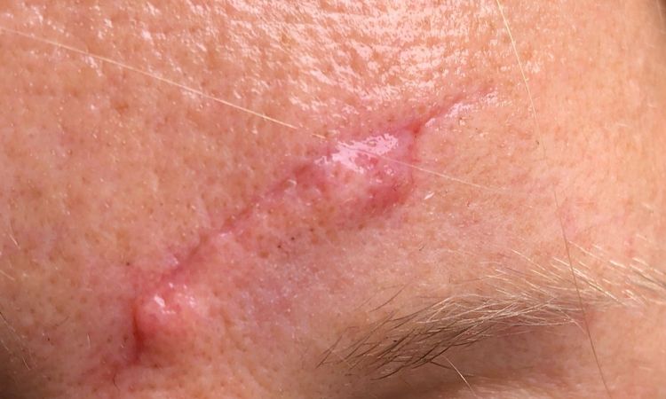 Wülstige frische Narbe auf Stirn verbessern - 28408
