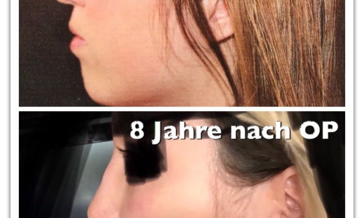 Nasenspitzenrevision nach offener funktioneller Septorhinoplastik - 28426