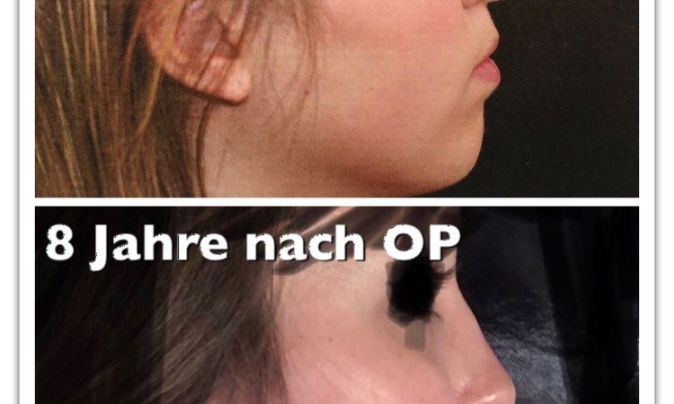 Nasenspitzenrevision nach offener funktioneller Septorhinoplastik - 28428