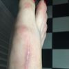 Narbenentfernung nach Hallux-OP