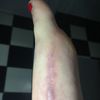 Narbenentfernung nach Hallux-OP