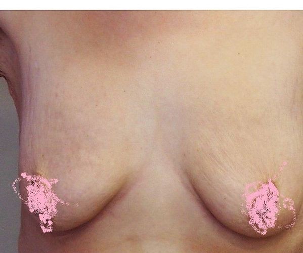 Erfahrungen Bruststraffung und Vergrößerung mit Eigenfett od Implantat?