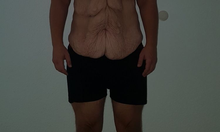 Fragen zu den Operationen: Abdominoplastik, Oberarm- und Oberschenkelstraffung - 28541