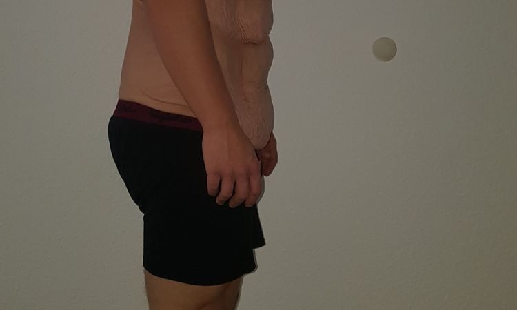 Fragen zu den Operationen: Abdominoplastik, Oberarm- und Oberschenkelstraffung - 28542