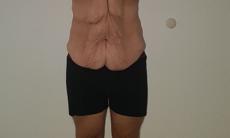 Fragen zu den Operationen: Abdominoplastik, Oberarm- und Oberschenkelstraffung - 28543