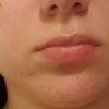 Gesichtsverschmälerung: Fett-weg Spritze oder Botulinumtoxin? - 28554