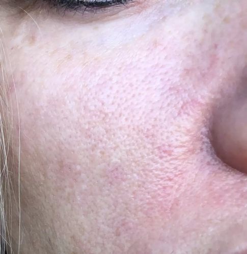 Welche Laser Methode für Gesicht?