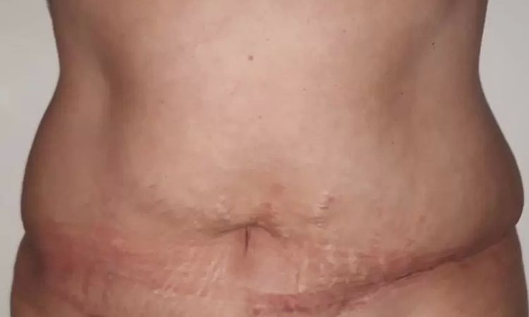Welche Art von Korrektur nach Bauchstraffung notwendig? - 28661