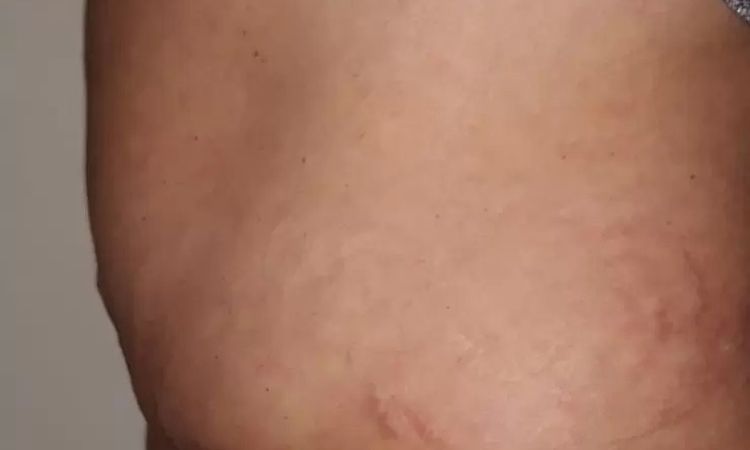 Welche Art von Korrektur nach Bauchstraffung notwendig? - 28663