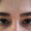 Augenlid-Korrektur bei müdem Ausdruck