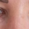 Welche Behandlung bei Falten unter den Augen? - 28760
