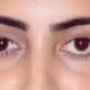 Symmetrie von ungleichen Augen durch Augenlidstraffung möglich? - 28767