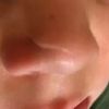 Behandlung einer Narbe am Nasenflügel bei 5-jährigem Junge - 28788