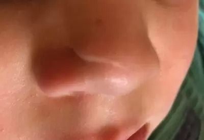 Behandlung einer Narbe am Nasenflügel bei 5-jährigem Junge
