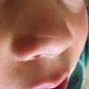 Behandlung einer Narbe am Nasenflügel bei 5-jährigem Junge - 28789