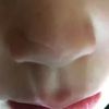 Behandlung einer Narbe am Nasenflügel bei 5-jährigem Junge - 28790