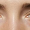 Augenringe und Tränensäcke Behandlungsmöglichkeiten - 28855
