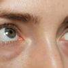 Augenringe und Tränensäcke Behandlungsmöglichkeiten - 28857
