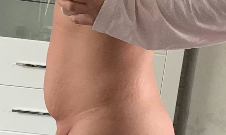 Fettschürze / Unterbauch nach Schwangerschaft - Welche  Möglichkeiten? - 28860