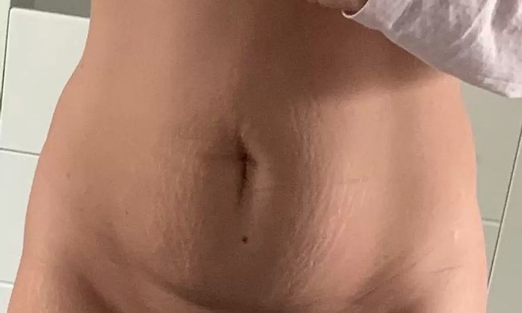 Fettschürze / Unterbauch nach Schwangerschaft - Welche  Möglichkeiten? - 28861