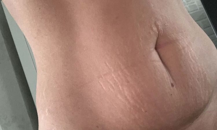 Fettschürze / Unterbauch nach Schwangerschaft - Welche  Möglichkeiten? - 28862