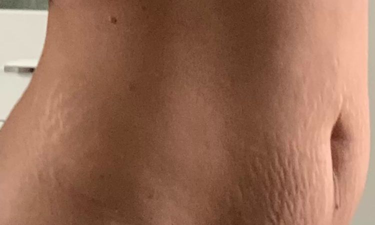 Fettschürze / Unterbauch nach Schwangerschaft - Welche  Möglichkeiten? - 28863