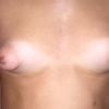 Tubuläre Brust / Brustvergrößerung und Straffung nötig?