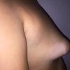 Tubuläre Brust / Brustvergrößerung und Straffung nötig?