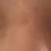 Augen ungleich- Oberlidstraffung nötig?
