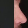 Korrektur der Nasenflügel ohne OP - 28909