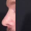 Korrektur der Nasenflügel ohne OP - 28910
