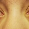 Welche Behandlungsmöglichkeiten bei tiefen und dunklen Augenringen?