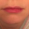 Asymmetrische Lippen: Korrektur möglich? - 28963