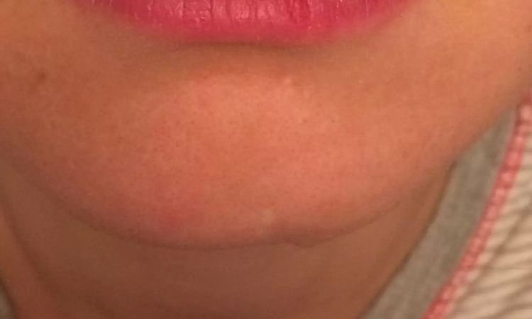 Asymmetrische Lippen: Korrektur möglich? - 28963