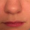 Asymmetrische Lippen: Korrektur möglich? - 28964