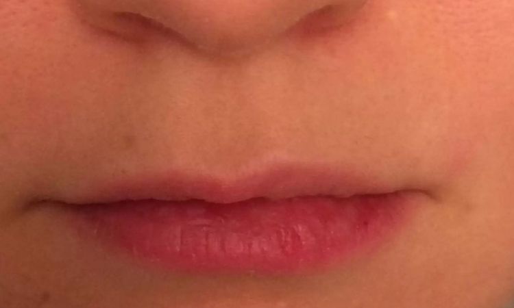 Asymmetrische Lippen: Korrektur möglich? - 28964