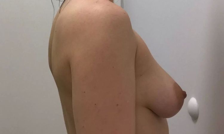 Hängende Brüste - Was für eine Bruststraffung wäre für mich die beste? - 28982