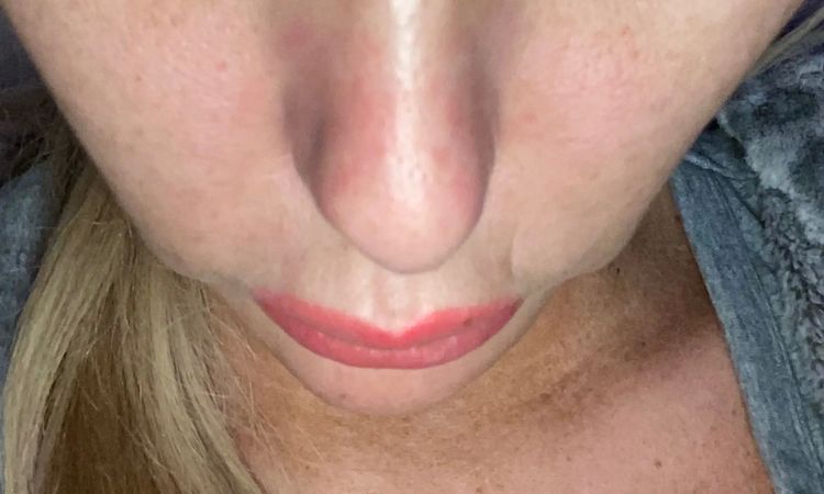 Mini Face Lifting mit 28 Jahren möglich? - 28997